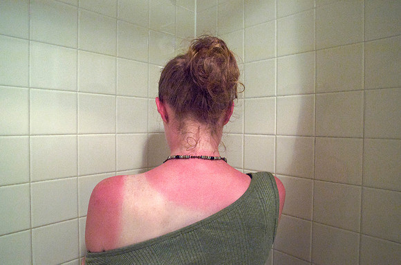 Climate Change - Increasing Threat of Sunburn